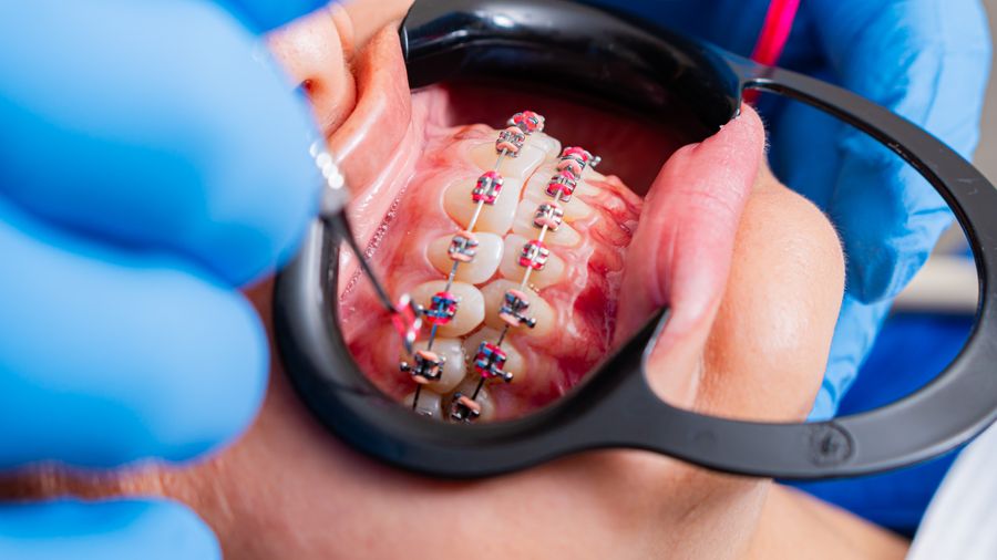 Fixed braces, seen with a cheek retractor